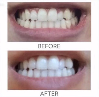 whitening_toothpaste_1